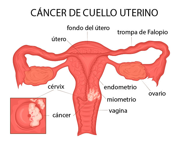 cancer cuello uterino