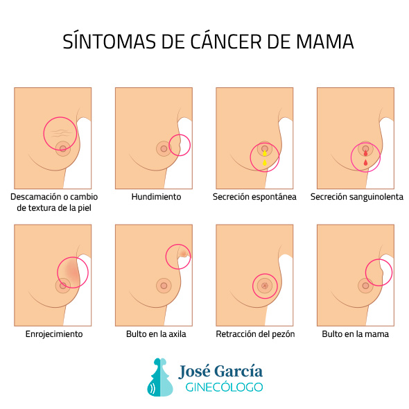 sintomas cancer mama