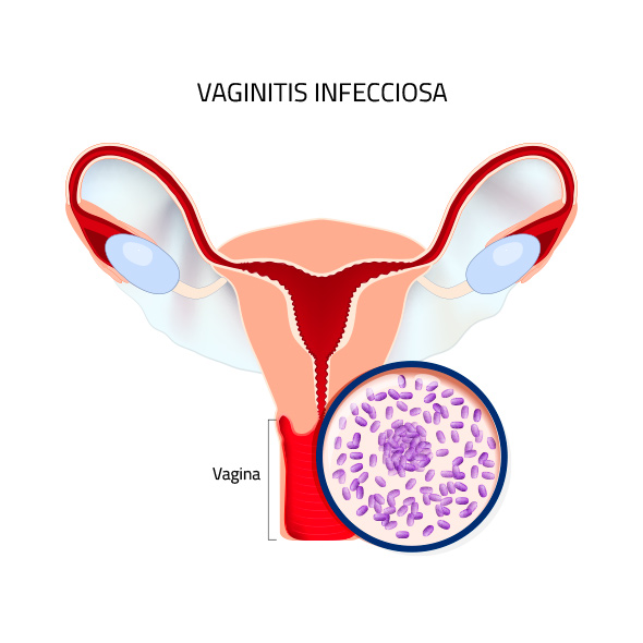 vaginitis infecciosa